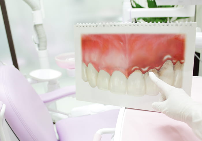 歯周病治療のイメージ