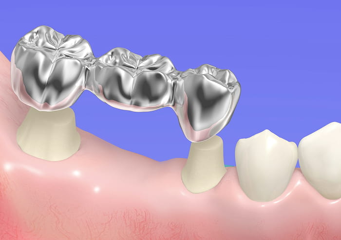ブリッジの説明イメージ