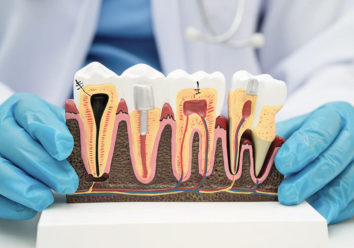 根管治療の模型イメージ